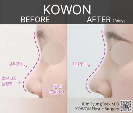 I Was Reborn with Small, Bulbous Nose Correction and Functional Nose Surgery for Deviated Septum at Kowon Plastic Surgery image 17