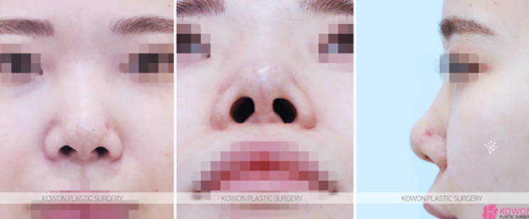 Q. 코수술 한달 붓기는 어느정도가 정상인지 궁금해요 관련 이미지 5