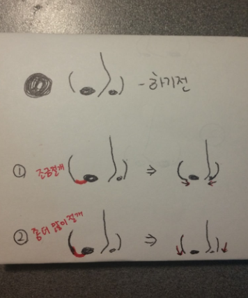 Q. 코절개방법에 따라 콧볼모양이 달라지나요? 관련 이미지 3