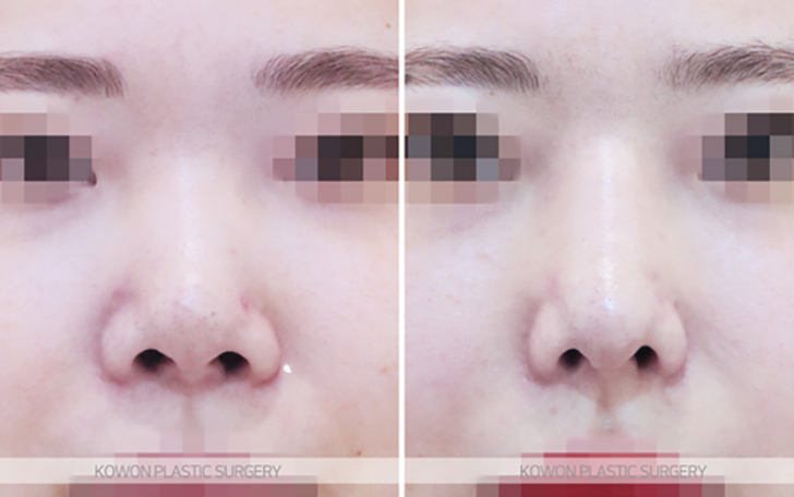 Q. Why Do the Nostrils Look Uneven After Revision Nose Surgery with Ear Cartilage? image 6