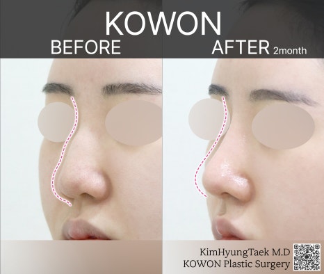 울퉁불퉁해 신경 쓰이던 코를 코원성형외과에서 낮은코와 매부리코교정으로 매끄럽게 만들었어요! 관련 이미지 22