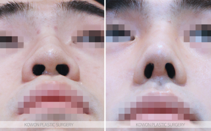 Q. The three-dimensional look that changes before and after male nose surgery: What changes are possible with male nose surgery? image 9