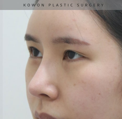 과도하게 화려한코, 귀연골에 비중격코수술로 자연스럽게 개선 됐어요! 관련 이미지 9