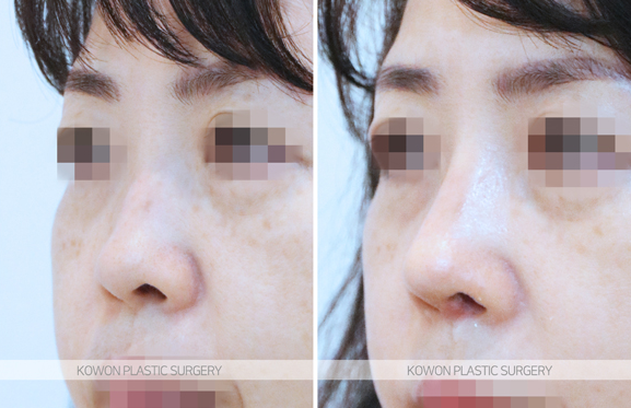 Q. I’m uncomfortable with swelling and nose pain after rhinoplasty due to a nasolabial fold implant image 3