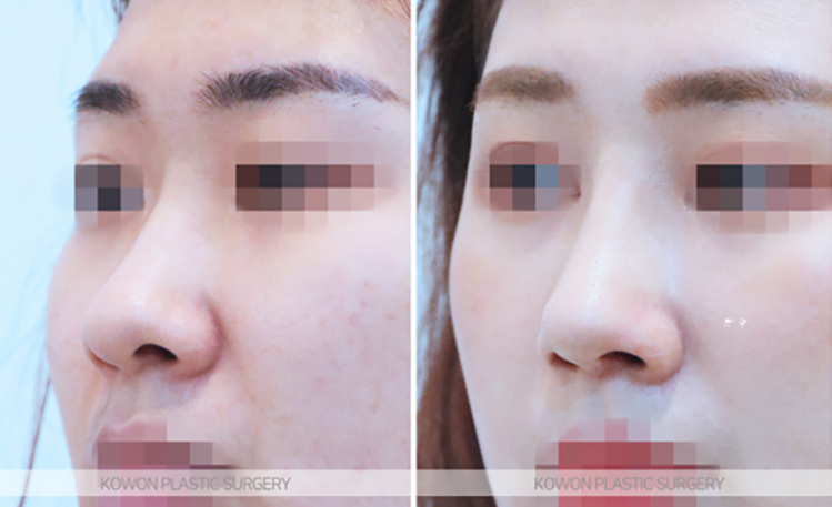 Q. Learn About Changes Before and After Alar Reduction Surgery Without Implants and Alar Reduction Surgical Methods image 7