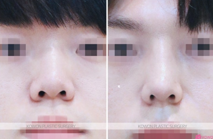 Q. 휜코수술 비대칭 코 컴플렉스, 코성형보험 되나요? 관련 이미지 5