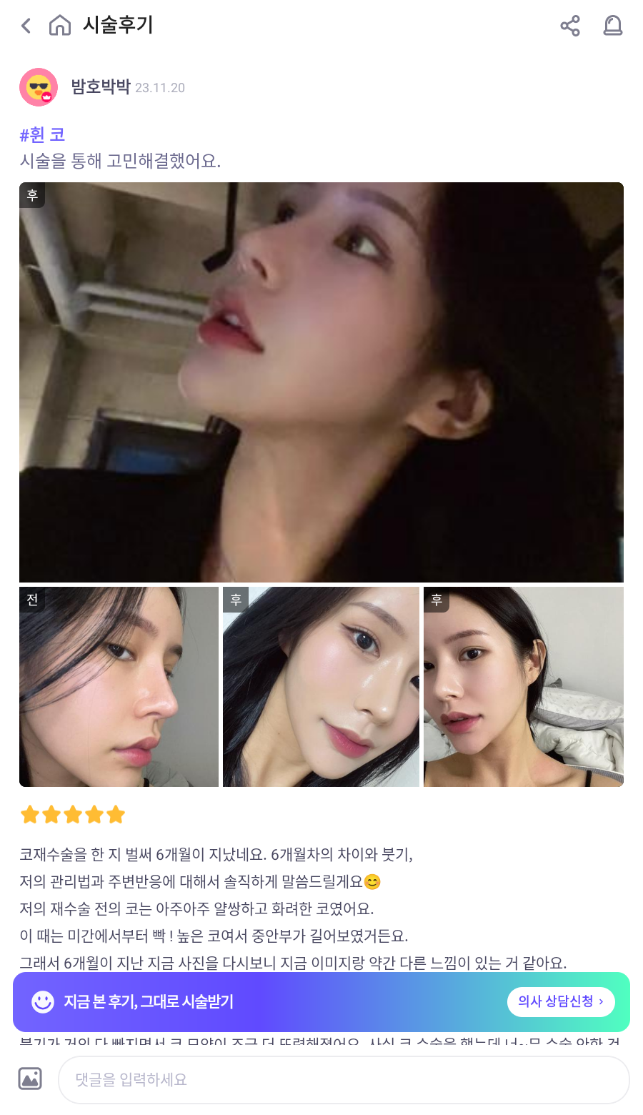 과도하게 화려한코, 귀연골에 비중격코수술로 자연스럽게 개선 됐어요! 관련 이미지 5