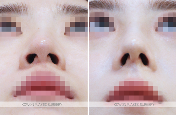 Q. Would nose fat-dissolving injections be effective? I’m wondering whether bulbous nose surgery or tip surgery is necessary image 6