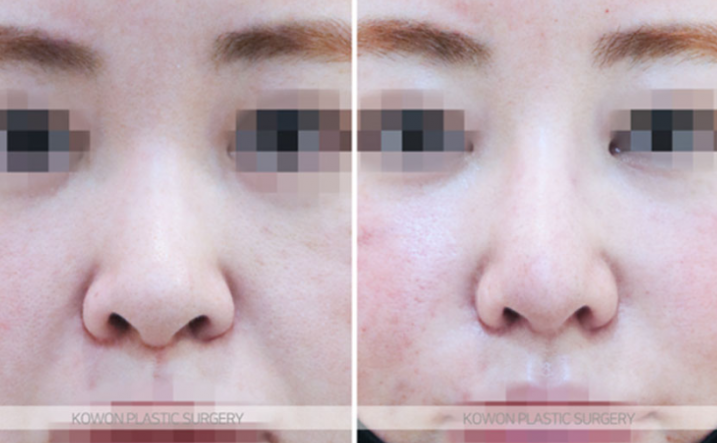 Q. Concerned about revision surgery for a long and wide nose: What is the key to natural-looking nose surgery results? image 3