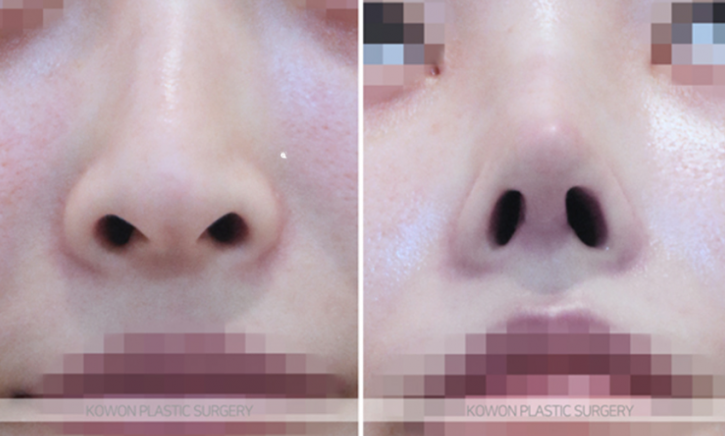Q. I’m worried that a 4 mm silicone implant for a nose bridge augmentation will look obvious image 7