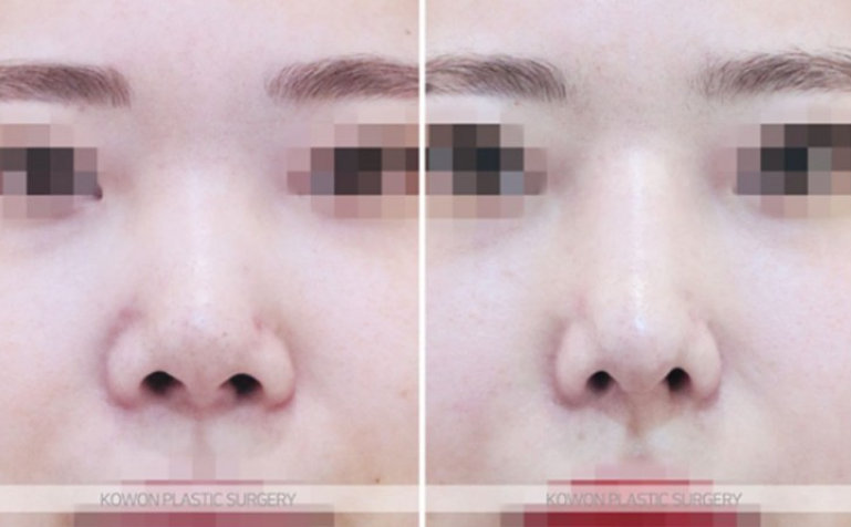 Will Autologous Rib Cartilage Nose Surgery Look Natural? A Process That Refined the Drooping Tip and Glabella Line image 6