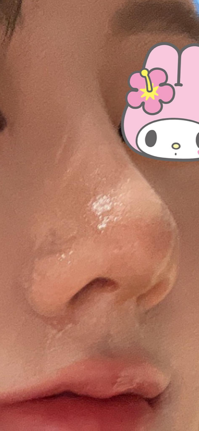 울퉁불퉁해 신경 쓰이던 코를 코원성형외과에서 낮은코와 매부리코교정으로 매끄럽게 만들었어요! 관련 이미지 7