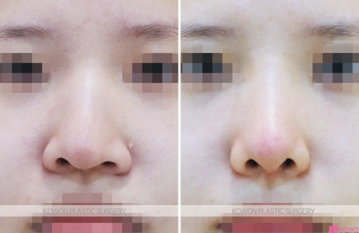 Q. Nasal Surgery Inflammation: Is Gore-Tex Implants with Ear Cartilage at the Tip Okay? image 5