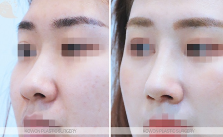 Q. Worried about inflammation after nose surgery, is severe pain after suture removal normal? image 6