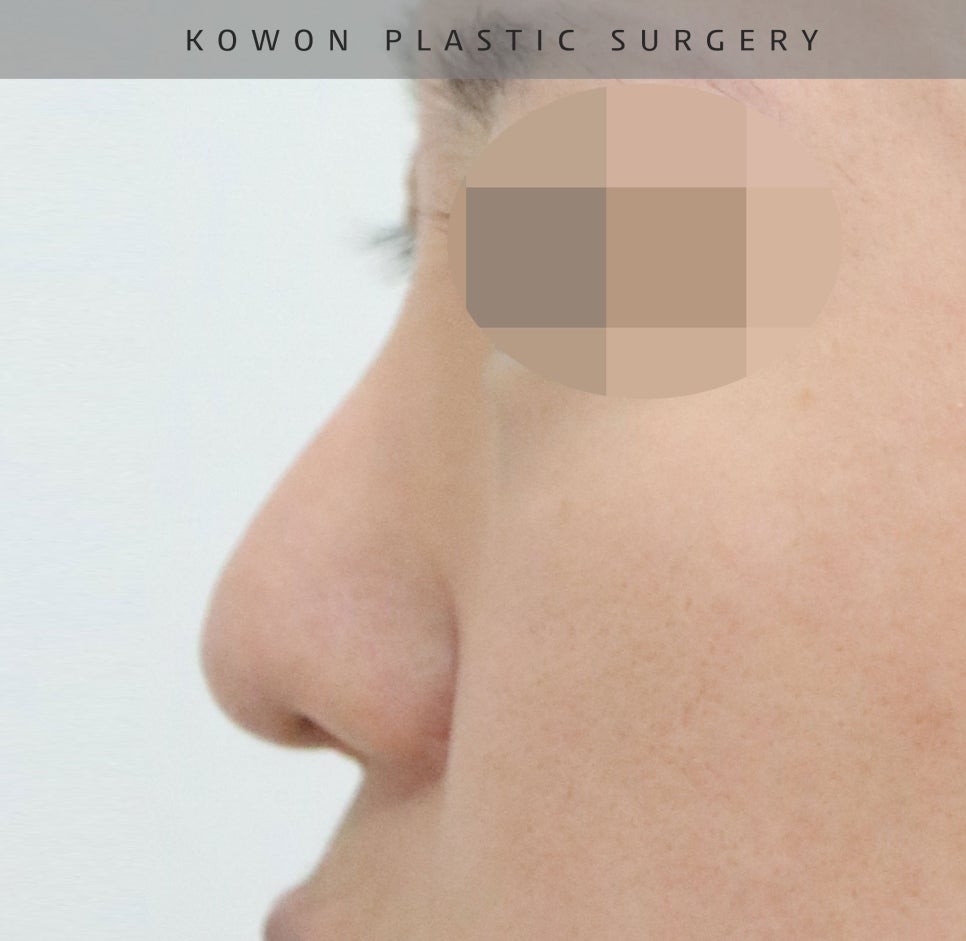 This is a review of nose surgery for a bulbous nose using donated rib cartilage at Kowon Plastic Surgery! image 14