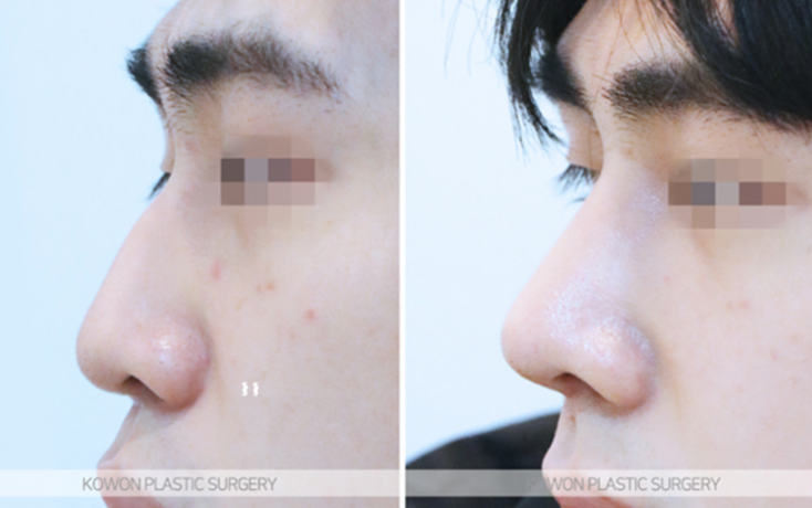 Q. The three-dimensional look that changes before and after male nose surgery: What changes are possible with male nose surgery? image 6