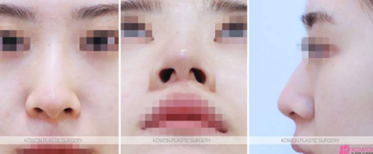 Q. 웃을때 화살코 수술 필요한데, 퍼진코수술 정보가 궁금해요 관련 이미지 4