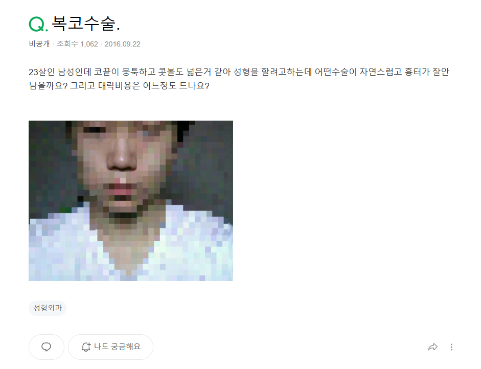 Q. 남자 콧볼축소수술 고민중인데 복코수술전후 결과가 궁금해요 관련 이미지 2