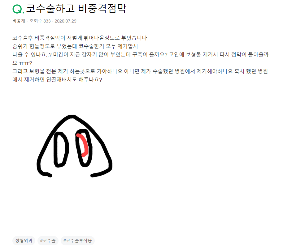 Q. It seems like the septal mucosa came out after the first nose surgery image 2