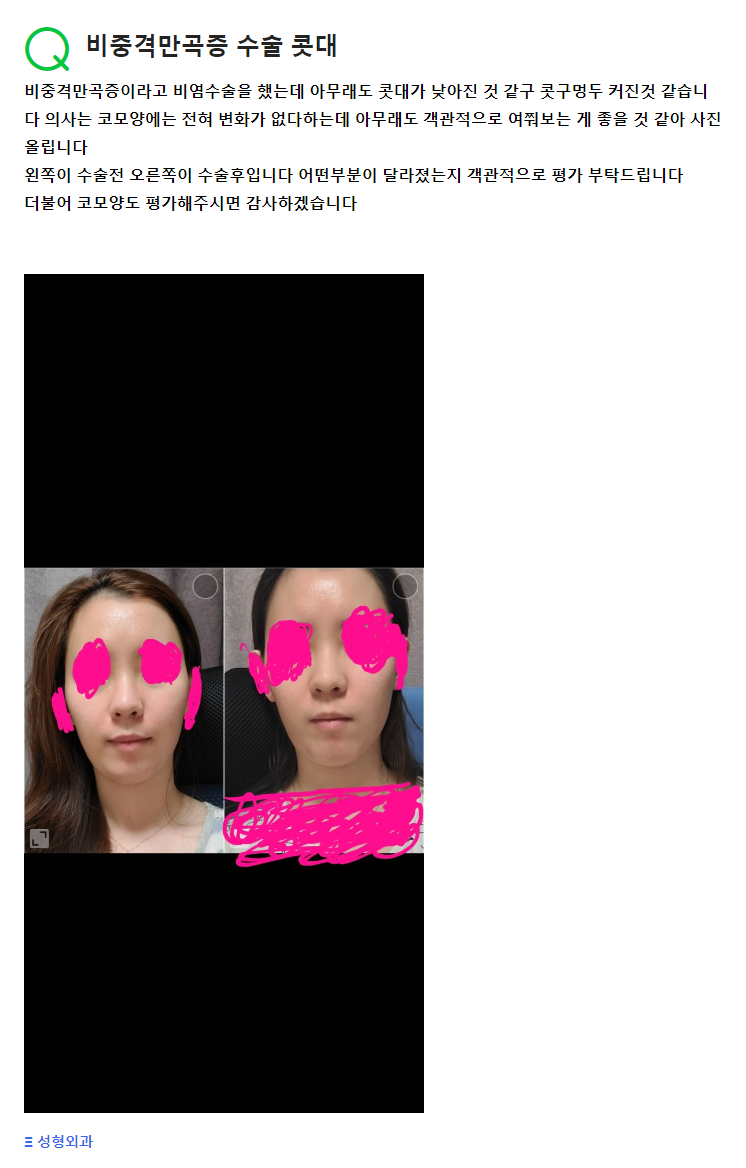 Q. Questions About the Bridge of the Nose After Functional Nose Surgery (Rhinitis Nose) and Deviated Septum Surgery image 2