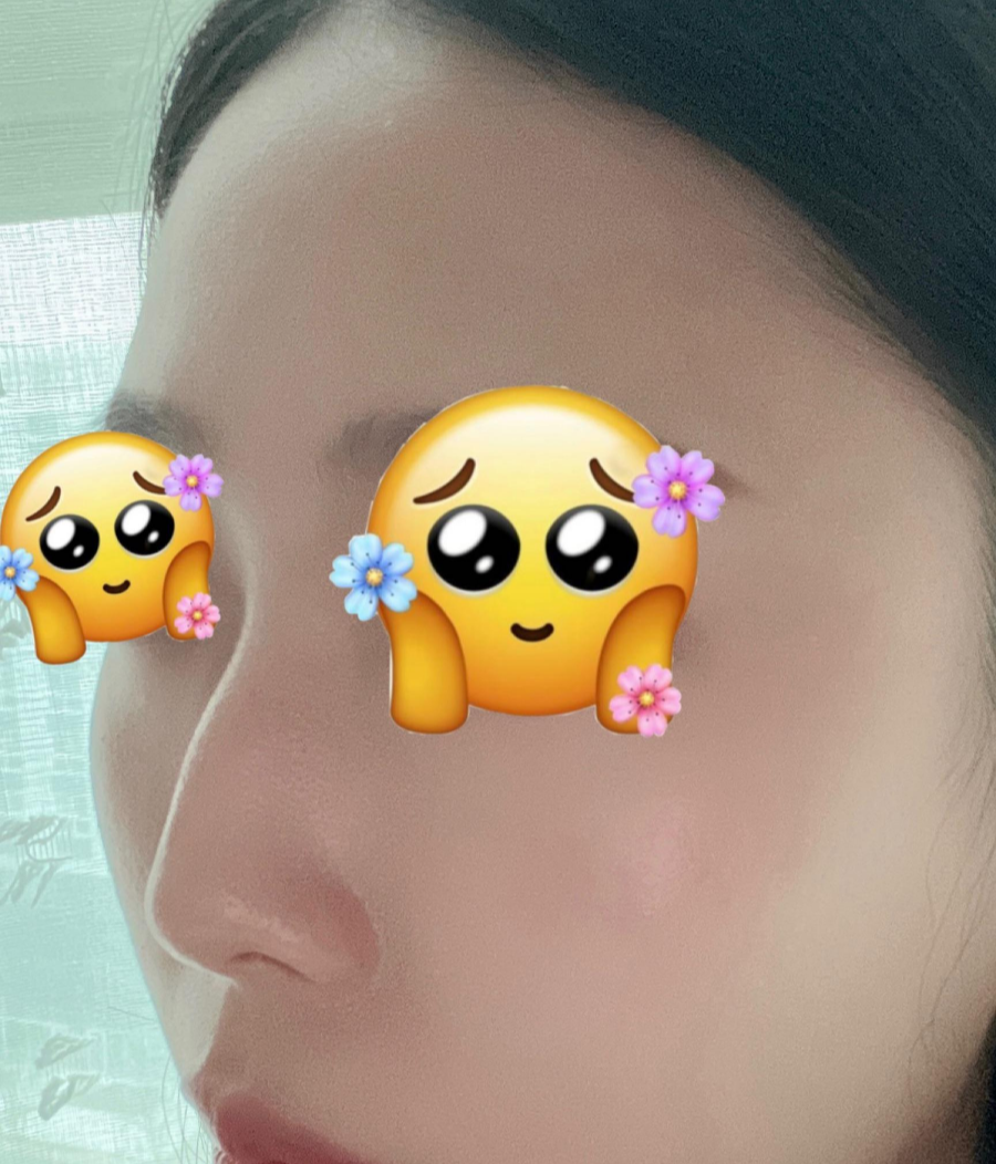 매부리코교정, 비염수술코성형까지 한번에 해결 됐어요! 관련 이미지 1