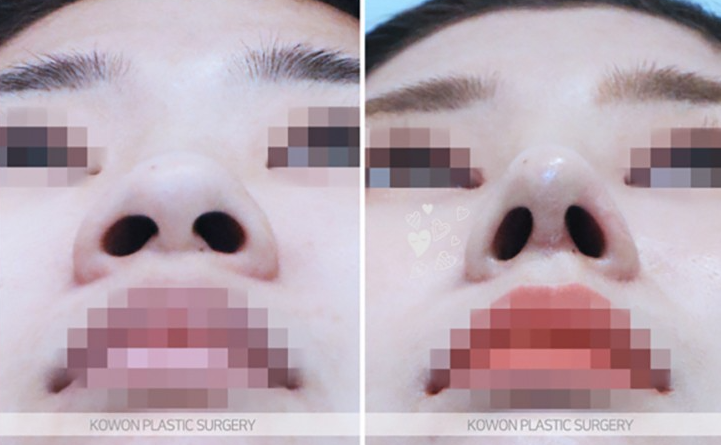 Q. Worried about inflammation after nose surgery, is severe pain after suture removal normal? image 5