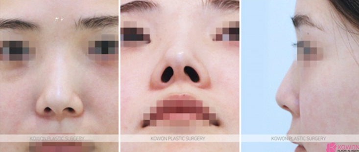 Q. I want to improve my nostrils without artificial implants in upturned nose surgery image 4
