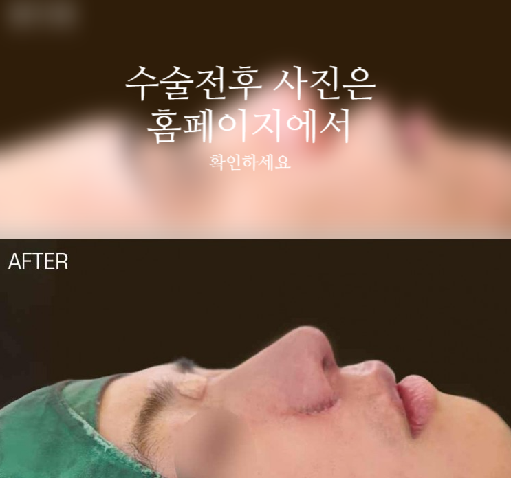 남자복코수술 매부리코와 콧볼을 함께 교정해야 자연스러운 이유 관련 이미지 2