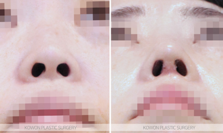 Q. I’m considering nose surgery in Seoul, and I have questions about the methods and safety of rhinoplasty image 7