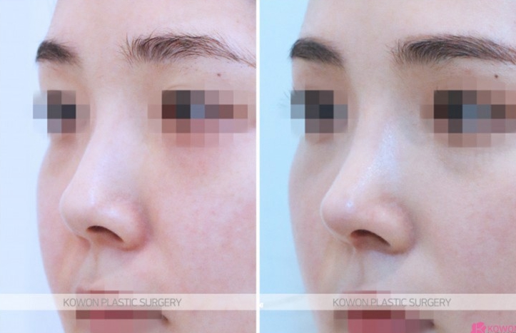 Q. After nose surgery, I had nasal congestion and blew my nose, and something foreign came out of my nose image 5