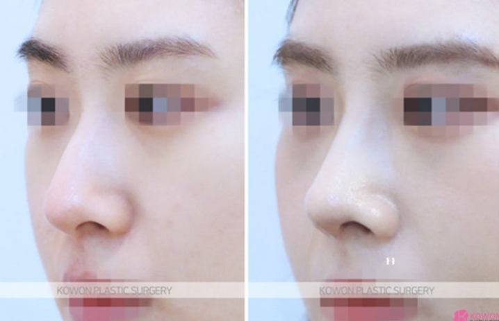 Q. Is non-open nose surgery possible? A complete guide to concerns about general anesthesia image 6