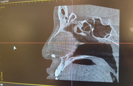 This is a review of nose surgery for a bulbous nose using donated rib cartilage at Kowon Plastic Surgery! image 11