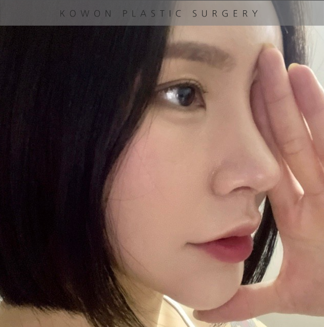 과도하게 화려한코, 귀연골에 비중격코수술로 자연스럽게 개선 됐어요! 관련 이미지 20