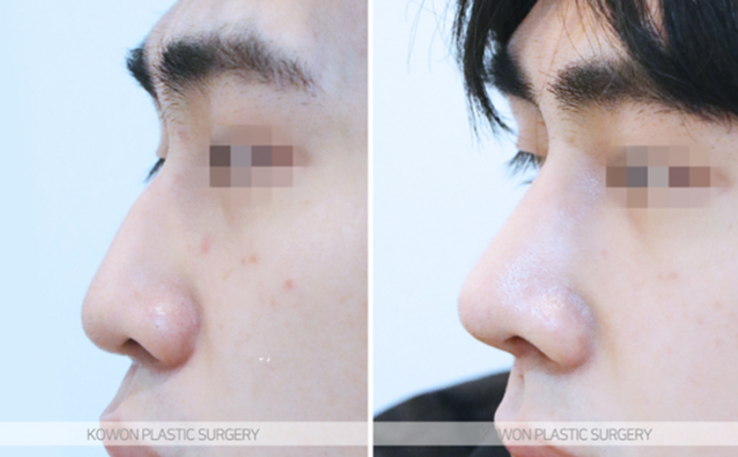 Q. The three-dimensional look that changes before and after male nose surgery: What changes are possible with male nose surgery? image 10