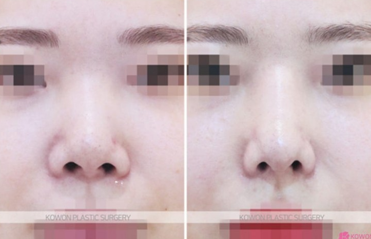 Q. I’m 고민 whether this is a side effect of cartilage nose surgery after revision rhinoplasty near Sinsa Station image 7