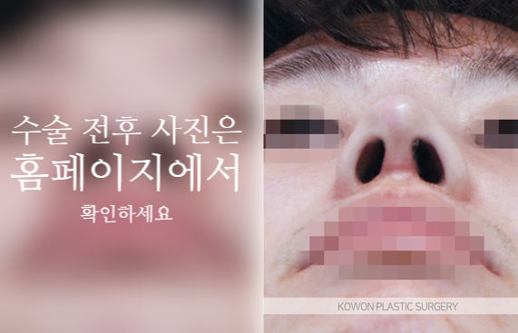 남자복코수술 매부리코와 콧볼을 함께 교정해야 자연스러운 이유 관련 이미지 7