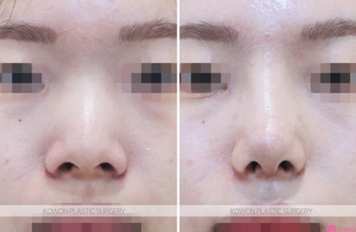 Q. I’m uncomfortable with swelling and nose pain after rhinoplasty due to a nasolabial fold implant image 5
