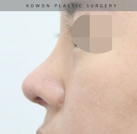 This is a review of nose surgery for a bulbous nose using donated rib cartilage at Kowon Plastic Surgery! image 16