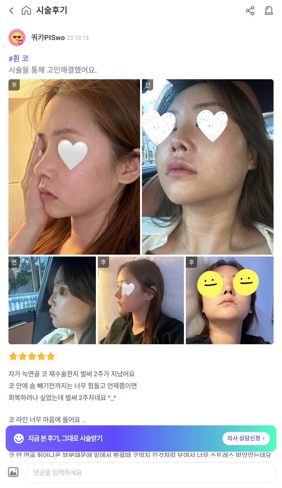Revision Rhinoplasty Using Autologous Rib Cartilage, I Resolved My Concerns Through Surgery! image 6
