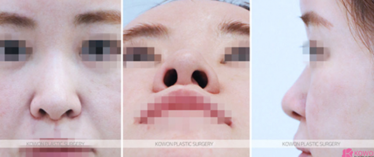 Q. I’m wondering whether my nose surgery swelling period needs more time to look natural, or whether revision surgery is necessary. image 4