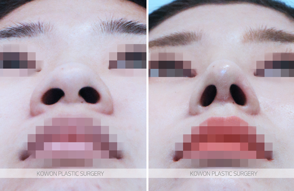 Q. 코성형통증, 코 여드름 짜서 보형물 이동한 걸까요? 관련 이미지 3