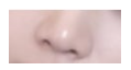 Q. Nostril Reduction Surgery? Reducing Nose Width? I Want to Improve My Broad, Bulbous Nose! image 4