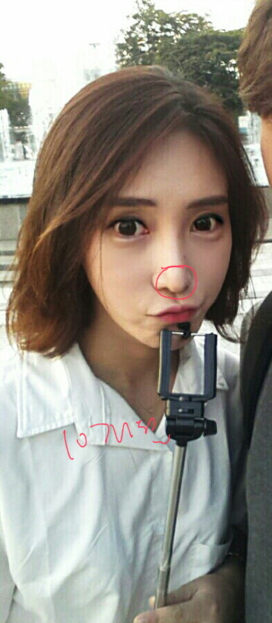 Q. 수술 후 코끝처짐, 개선 방법이 코재수술밖에 없나요? 관련 이미지 8