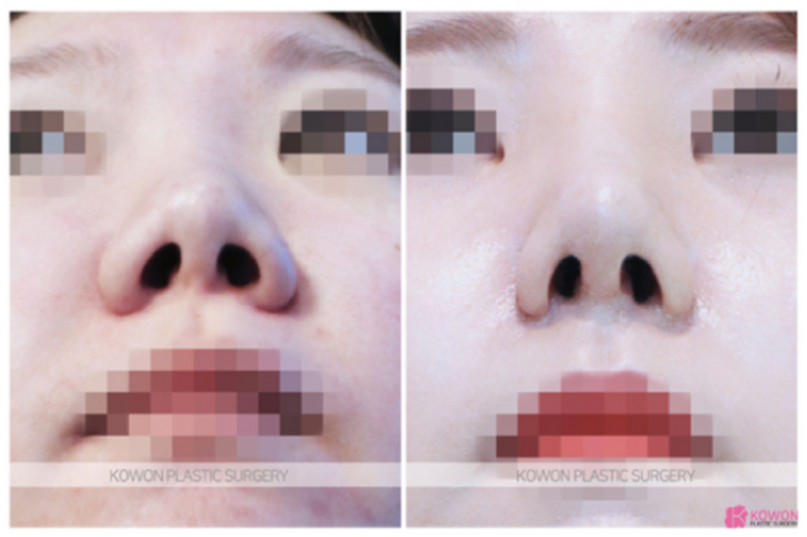 콧날개수술, 단순히 콧볼만 줄이는 수술일까요? | 코원성형외과 관련 이미지 3