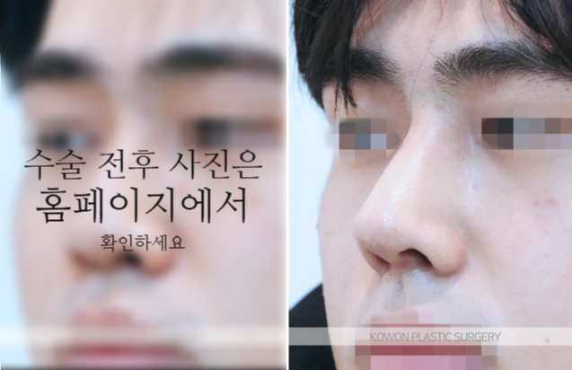 남자매부리코 교정, 비중격만곡증까지 함께 고려해야 하는 이유 관련 이미지 6