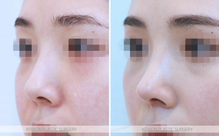 Q. I want to improve my nostrils without artificial implants in upturned nose surgery image 5