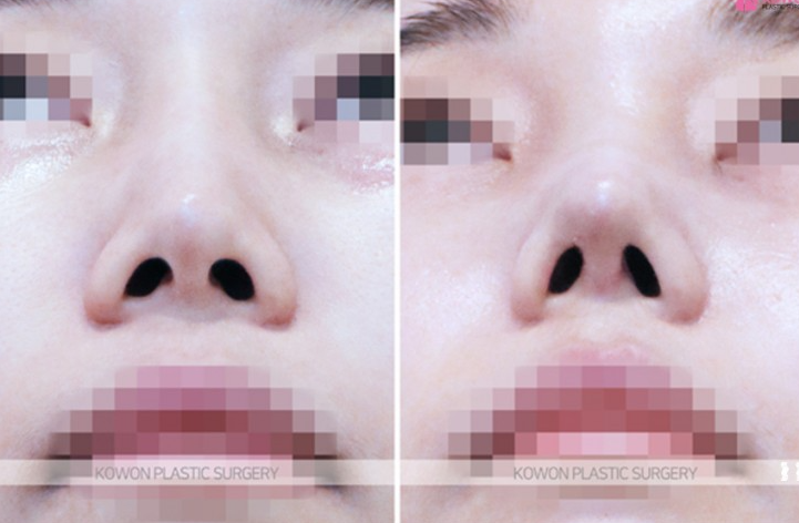 Q. Considering Surgery for the Bridge Between the Eyebrows and the Nose: Side Effects of Nasal Bridge Surgery and Key Points for Revision Surgery image 9