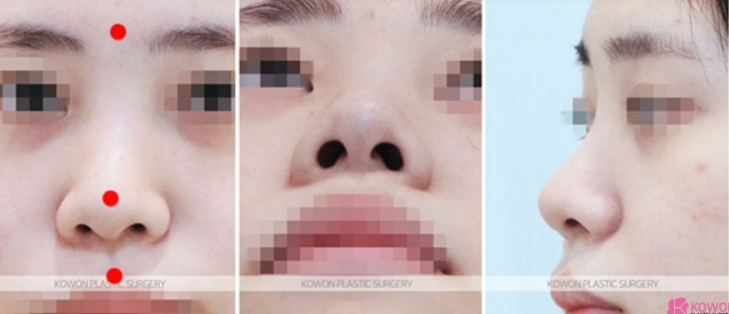 Q. 코성형 회복기간 동안 붓기와 피고임 구분, 콧대재수술 시기 정리 관련 이미지 3