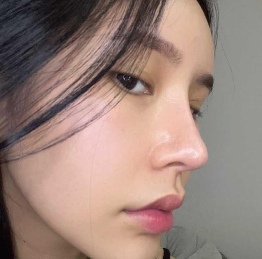 과도하게 화려한코, 귀연골에 비중격코수술로 자연스럽게 개선 됐어요! 관련 이미지 1