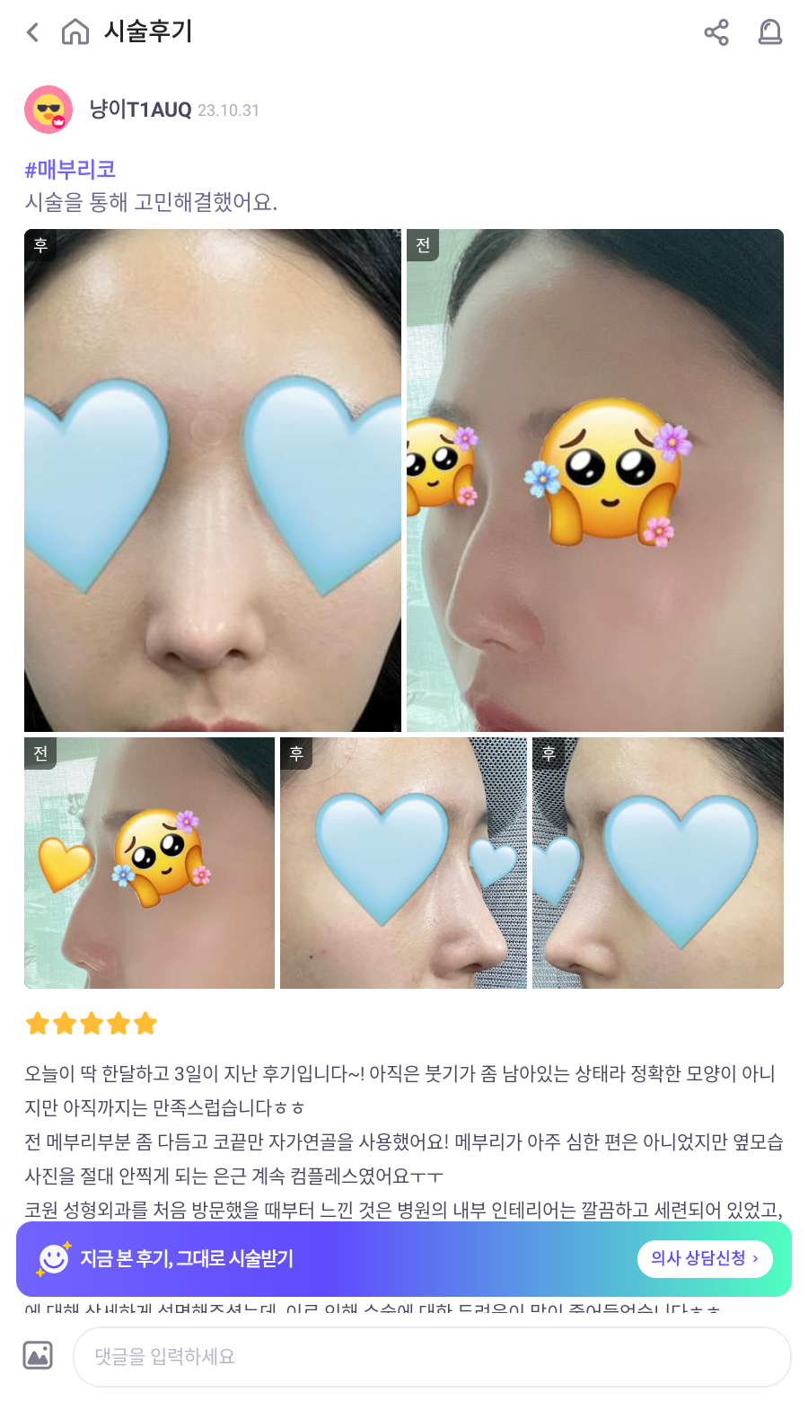 매부리코교정, 비염수술코성형까지 한번에 해결 됐어요! 관련 이미지 6